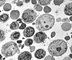 M,71y. | blood - blastic elements M,71y. | blood - blastic elements